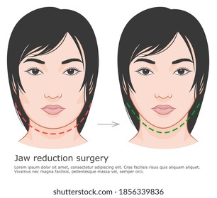 
Jaw reduction surgery asian face. Mandibuloplasty surgery before and after illustration. V-line surgery. 