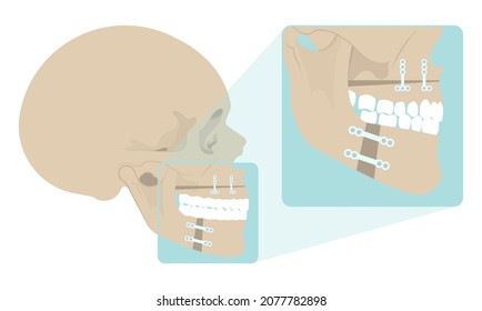 Jaw Surgery Chin Implant Sleep Apnea Snoring Upper Airway Plastic Facial Cranio TMD TMJ Joint Overbite Teeth Dental Birth Defects Open Bite Pain Trauma Cosmetic Gummy Smile Bone Reconstructive Bad