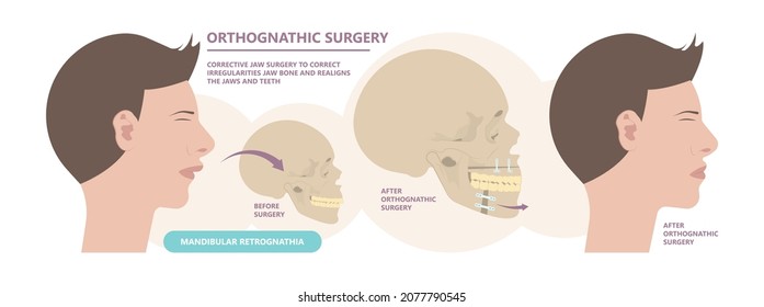 Jaw Surgery chin implant Sleep Apnea snoring upper airway plastic facial Cranio TMD TMJ joint Overbite teeth dental birth defects Open bite pain trauma cosmetic gummy smile bone reconstructive bad