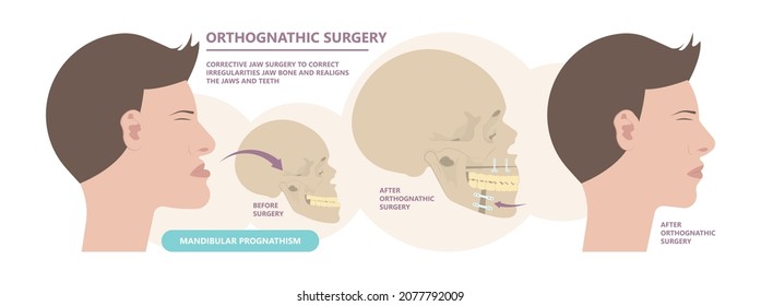 Jaw Surgery Chin Implant Sleep Apnea Snoring Upper Airway Plastic Facial Cranio TMD TMJ Joint Overbite Teeth Dental Birth Defects Open Bite Pain Trauma Cosmetic Gummy Smile Bone Reconstructive Bad