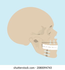 Jaw Surgery chin implant Sleep Apnea snoring upper airway plastic facial Cranio TMD TMJ joint Overbite teeth dental birth defects Open bite pain trauma cosmetic gummy smile bone reconstructive bad