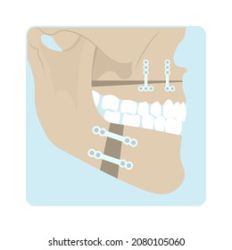 Jaw Surgery Chin Implant Sleep Apnea Snoring Upper Airway Plastic Facial Cranio TMD TMJ Joint Overbite Teeth Dental Birth Defects Open Bite Pain Trauma Cosmetic Gummy Smile Bone Reconstructive Bad