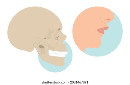 Jaw Surgery chin implant Sleep Apnea snoring upper airway plastic facial Cranio TMD TMJ joint Overbite teeth dental birth defects Open bite pain trauma cosmetic gummy smile bone reconstructive bad