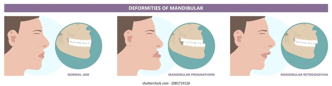 Jaw Surgery chin implant Sleep Apnea snoring upper airway plastic facial Cranio TMD TMJ joint Overbite teeth dental birth defects Open bite pain trauma cosmetic gummy smile bone reconstructive bad