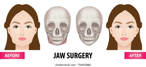 Jaw surgery vector illustration 