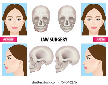 Jaw surgery vector illustration