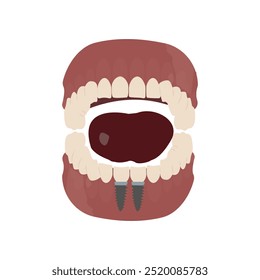 Mandíbula com Dois Implantes Dentários: Representação Visual da Cirurgia Oral