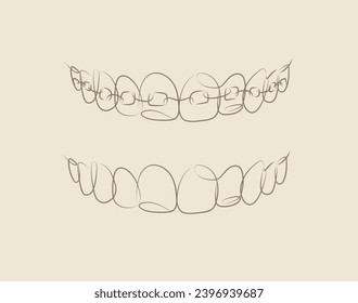 Jaws with and without braces installed drawing in linear style on beige background