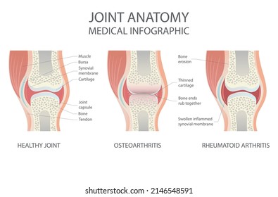 Joint anatomy. Normal and arthritic human joints. Types of arthritis. Vector graphic illustration.