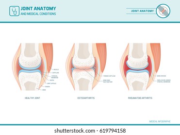 Joint anatomy, osteoarthritis and rheumatoid arthritis infographic with anatomical illustrations