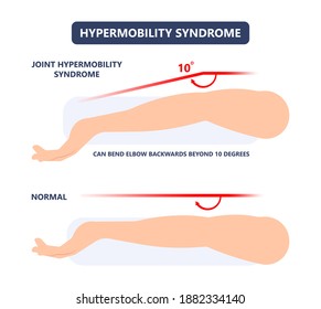 Joint Bend Wrist Knee Leg Pain Ehlers Danlos Test Elbow Arm Marfan Jointed Body Gene Loose Range Of Motion Fragile Tear Flexible Stretchy Laxity Injury