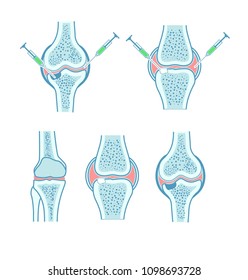 Joint Bone Cartilage Injection