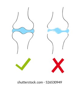 Joint with cartilage and arthritis.Vector illustration.