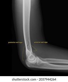 Joint effusion elbow vector xray