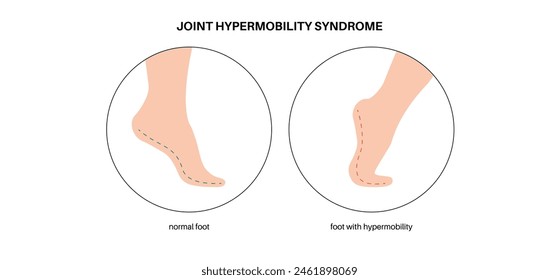 Joint hypermobility syndrome or hypermobility spectrum disorder. Abnormal large range of movement in human legs. Elastic, and stretchy skin and limbs in the human body medical flat vector illustration