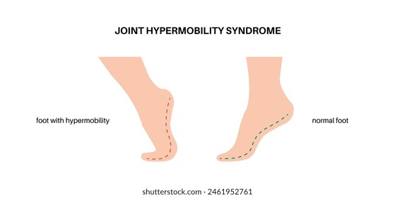 Joint hypermobility syndrome or hypermobility spectrum disorder. Abnormal large range of movement in human legs. Elastic, and stretchy skin and limbs in the human body medical flat vector illustration
