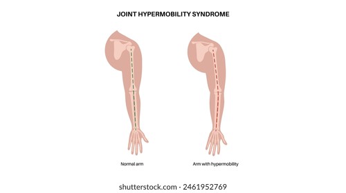 Joint hypermobility syndrome or hypermobility spectrum disorder. Abnormal large range of movement in human arms. Elastic, and stretchy skin and limbs in the human body medical flat vector illustration