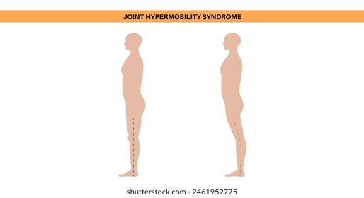 Joint hypermobility syndrome or hypermobility spectrum disorder. Abnormal large range of movement in human legs. Elastic, and stretchy skin and limbs in the human body medical flat vector illustration