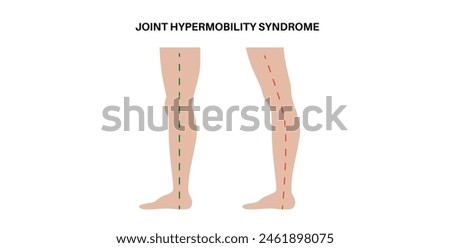 Joint hypermobility syndrome or hypermobility spectrum disorder. Abnormal large range of movement in human legs. Elastic, and stretchy skin and limbs in the human body medical flat vector illustration