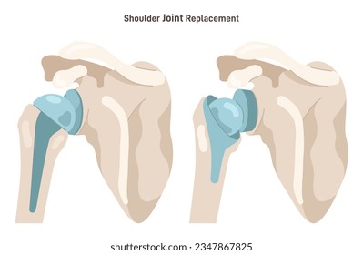 Joint implantation. Injured or distracted human joint replaced with artificial prosthesis made of titanium. Osteoporosis and osteoarthritis treatment surgery. Flat vector illustration