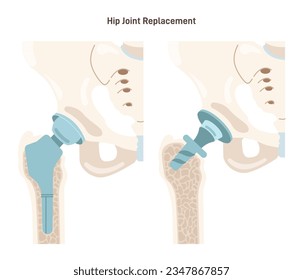 Joint implantation. Injured or distracted human joint replaced with artificial prosthesis made of titanium. Osteoporosis and osteoarthritis treatment surgery. Flat vector illustration