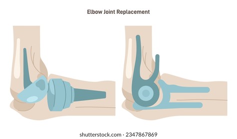 Joint implantation. Injured or distracted human joint replaced with artificial prosthesis made of titanium. Osteoporosis and osteoarthritis treatment surgery. Flat vector illustration