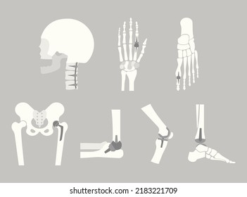 Joint implants in human skeleton cartoon illustration set. Different finger, knee, leg, ankle replacement prothesis. Arthritis, rheumatoid, healthcare, surgery, anatomy, disease concept