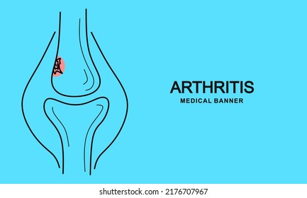 Joint pain banner. Bone, injury, disease. Arthritis concept. Can be used for topics like symptom, healthcare, anatomy. Medical banner template. Vector illustration