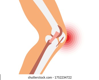 Joint Pain Illustration. Bone Pain. Ache. Arthritis. Orthopedic Medical Icon. Human Leg Anatomy.