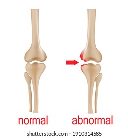 Joint pain illustration. Bone pain. Ache. Arthritis. Orthopedic medical concept.