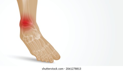 Joint pain illustration. Bone pain. Ache. Arthritis. Orthopedic medical concept.