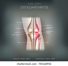 Joint problems osteoarthritis, healthy joint and damaged joint illustration