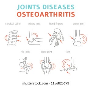 Joints diseases. Arthritis, osteoarthritis symptoms, treatment icon set. Medical infographic design. Vector illustration