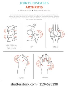 Joints diseases. Arthritis symptoms, treatment icon set. Medical infographic design.  Vector illustration