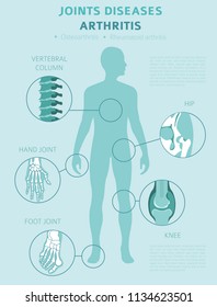 Joints diseases. Arthritis symptoms, treatment icon set. Medical infographic design.  Vector illustration