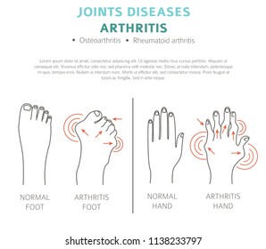 Joints diseases. Arthritis symptoms, treatment icon set. Medical infographic design.  Vector illustration