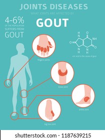 Joints Diseases Gout Symptoms Treatment Icon Stock Vector (Royalty Free ...