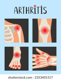 Uniones del esqueleto humano con puntos rojos dolorosos. Ilustración vectorial de la artritis reumatoide sobre la inflamación. Cuerpo de artritis y esqueleto de anatomía