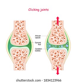 Joints and popping sound. Physiological Mechanism of cavitation. manipulate the joint we will get sound this is rapid movement of gas bubbles within the synovial solution. Cracking joint