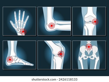 Conjunto de iconos como la imagen de rayos X. Enfermedad y trastorno en hombro, rodilla, tobillo, muñeca y pelvis. Artritis, osteoporosis, reumatismo, inflamación, fractura. Articulaciones y partes del cuerpo con anillos de dolor