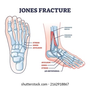 Jones fracture and foot pinky finger bone broken damage outline diagram. Labeled educational scheme with bone stress or avulsion sections vetor illustration. Peroneus brevis and tertius muscle anatomy