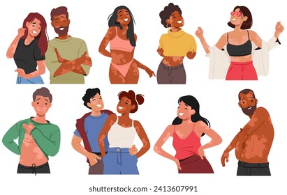 Joyful People Characters Proudly Embracing Their Unique Beauty With Vitiligo, Radiating Happiness And Confidence, Challenging Societal Norms And Promoting Self-love And Acceptance. Vector Illustration