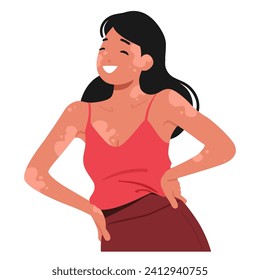 Joyful Woman Embraces Her Unique Beauty With Vitiligo, Radiating Confidence And Self-love. Her Smile Reflects Resilience, Celebrates Diversity, Inspiring Positivity And Acceptance. Vector Illustration