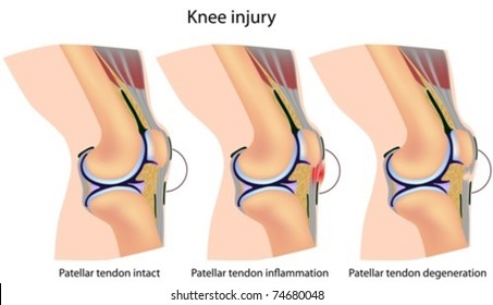 Jumper's knee anatomy