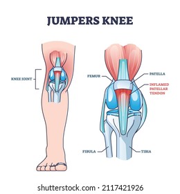 Jumpers knee or patellar tendonitis tendon bone inflammation outline diagram. Labeled educational anatomical scheme with leg skeletal structure vector illustration. Inflamed and painful joint problem.