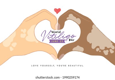 June 25th - World Vitiligo Day. People with skin problems Vitiligo. Two hands making heart shape gesture isolated on white. Body positive self love flat design. Depigmentation disease.