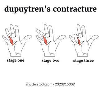 Jupuytren contracture. Black and white infographic with disease stages. Medical poster. Vector illustration