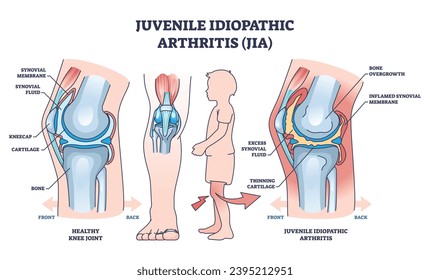 Juvenile idiopathic arthritis or JIA anatomical explanation outline diagram. Labeled educational medical scheme with healthy and diseased joint comparison vector illustration. Child bone illness.