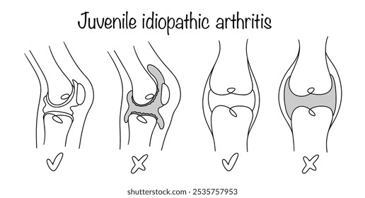 Artrite idiopática juvenil. Inflamação crônica persistente das articulações. Articulação do joelho saudável e doente. Ilustração de vetor preto e branco para uso no campo médico.