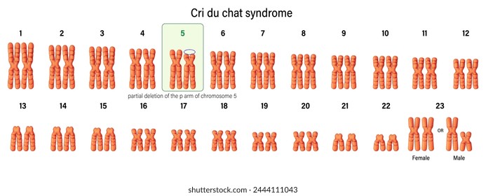 Karyotype of Cri du chat syndrome. Autosomal abnormalities. A partial deletion of the p arm of chromosome 5.